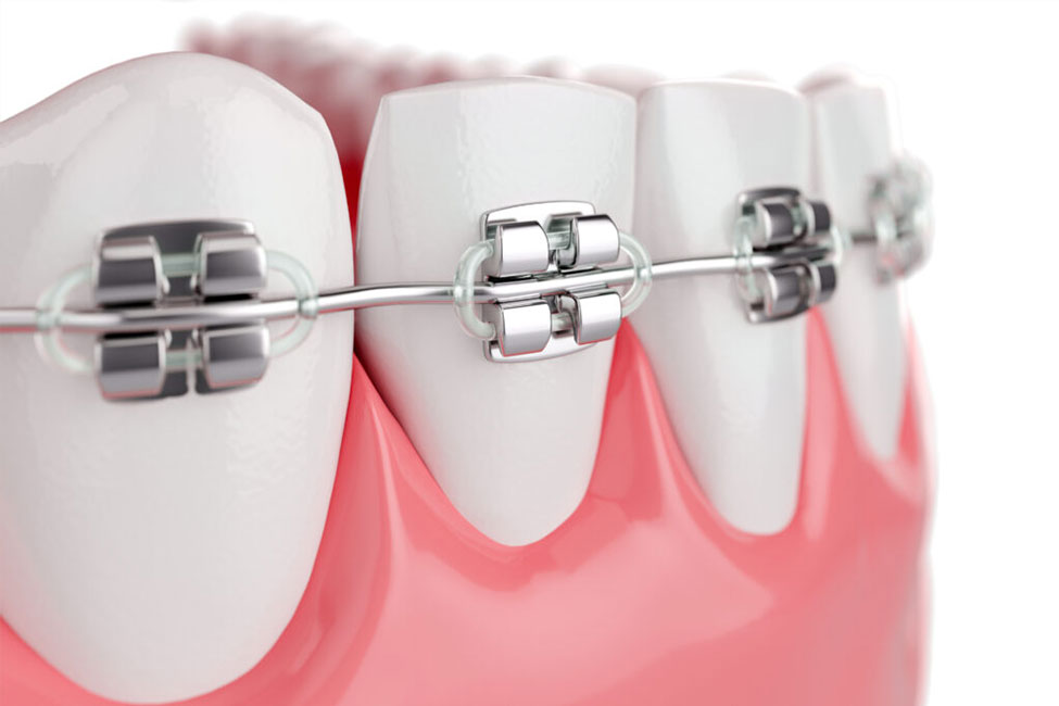 Invisible braces treatment in chennai