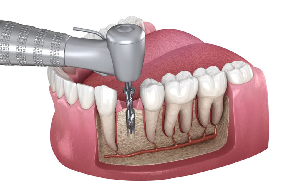 Root canal treatment in Thiruvanmiyur